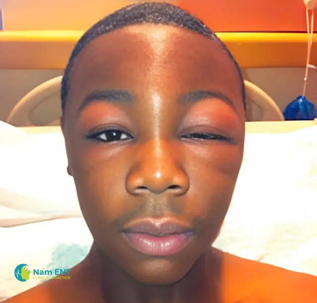 child presents with a swollen eye